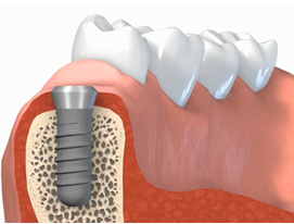 implant-1